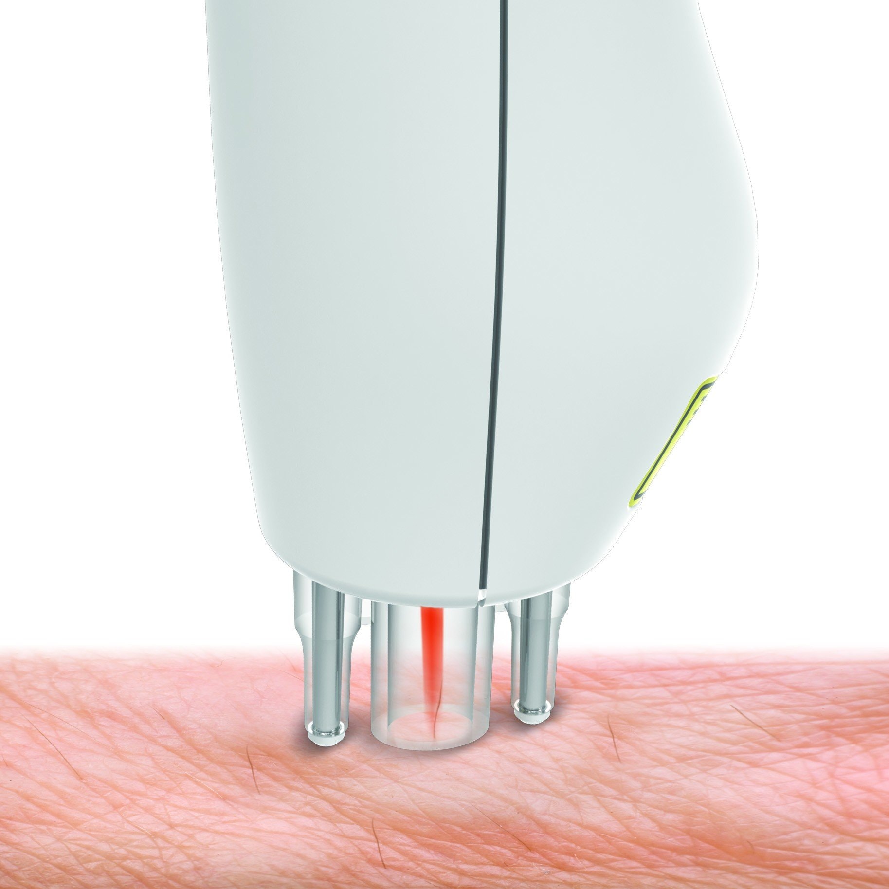 Epilateur laser RIO  - TWEEZER